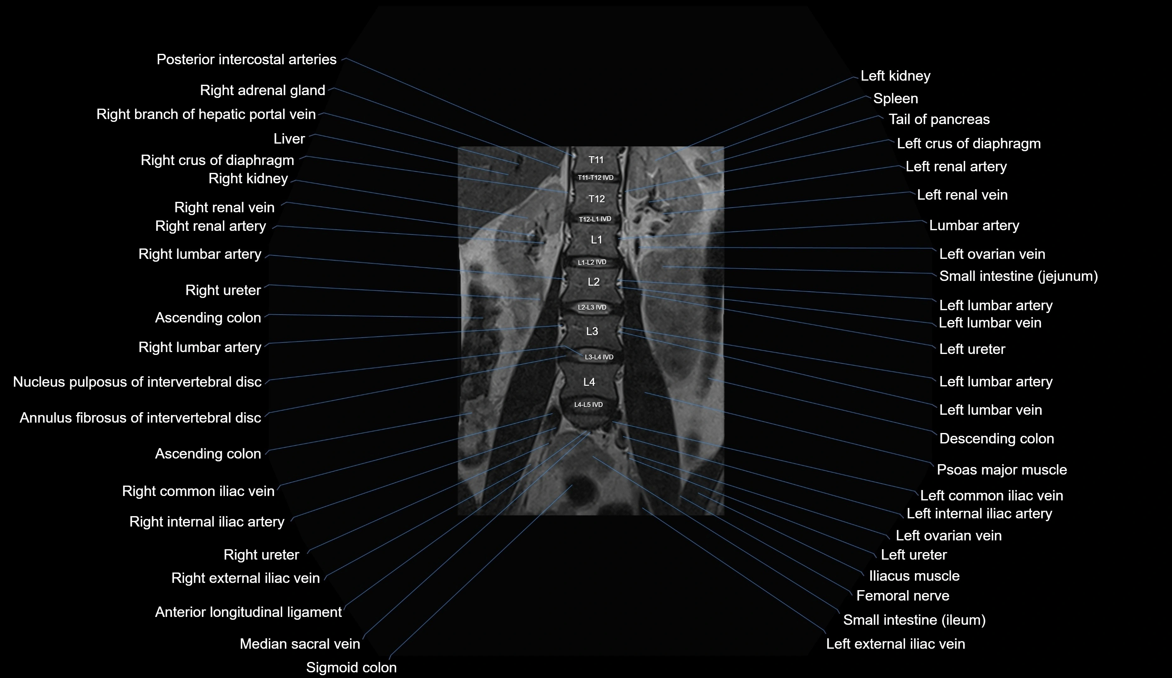 MRI lumbar spine coronal cross sectional anatomy 3T radiology  image-img-00001-00010.webp